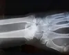 Lipiciul pentru oase care repară fracturile în câteva minute șochează lumea medicală