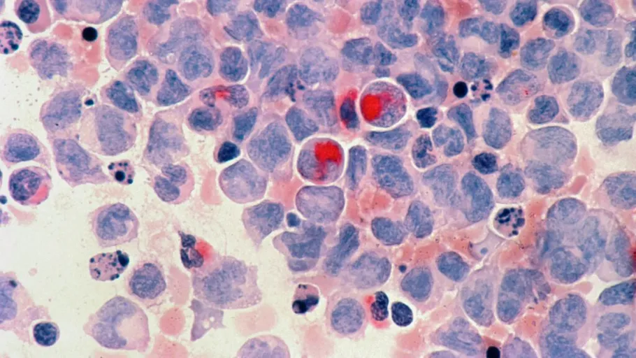 A apărut un nou colos medical în lupta împotriva cancerului