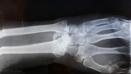 Lipiciul pentru oase care repară fracturile în câteva minute șochează lumea medicală