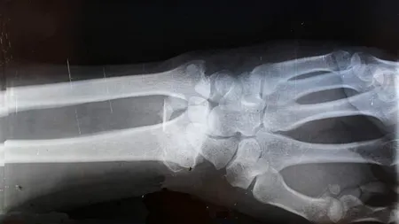 Lipiciul pentru oase care repară fracturile în câteva minute șochează lumea medicală