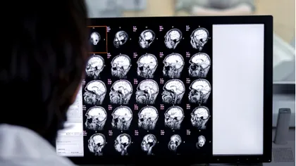 Atlasul creierului uman dezvăluie legături neașteptate între gene, cancer și tulburările psihice