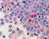 A apărut un nou colos medical în lupta împotriva cancerului