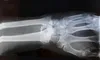 Lipiciul pentru oase care repară fracturile în câteva minute șochează lumea medicală