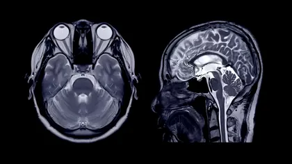 Un simplu RMN al creierului poate indica ritmul real al îmbătrânirii, susțin cercetătorii